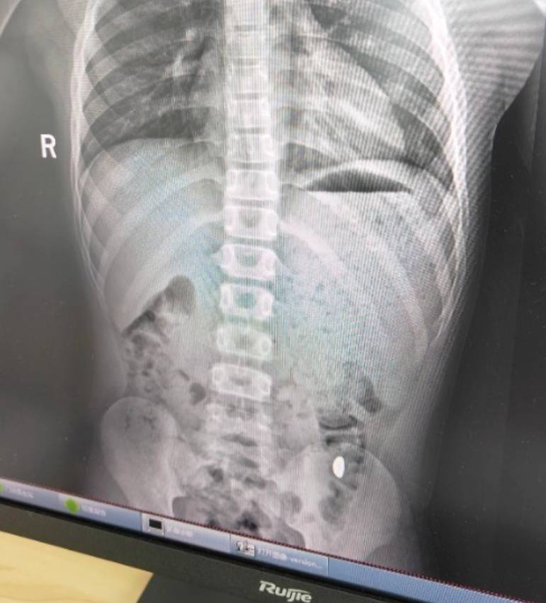 “熊孩子”误吞10克重金豆,妈妈:天天叮嘱他不要在外面拉屎