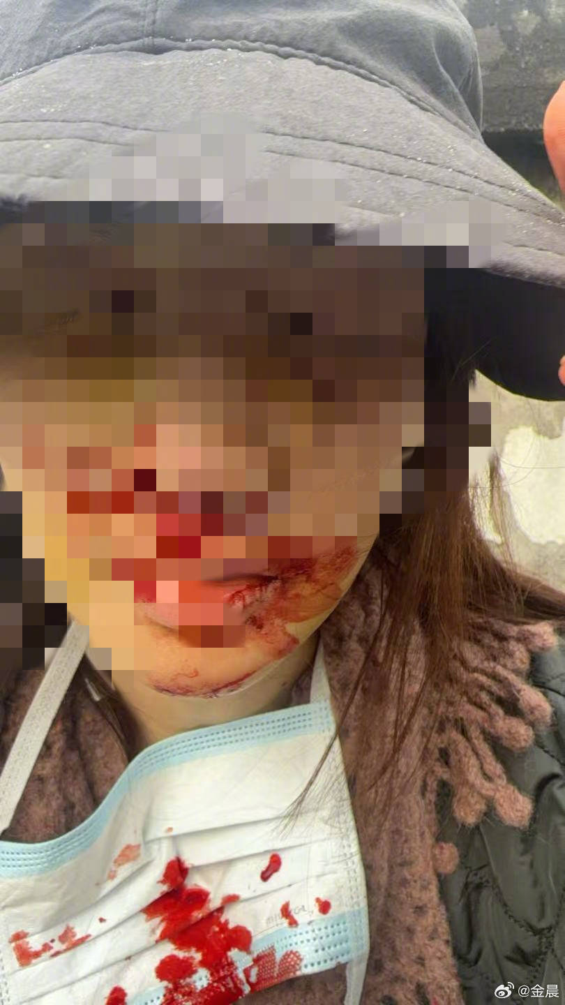 警方发布警情通报后，金晨晒脸部受伤照片并发文道歉